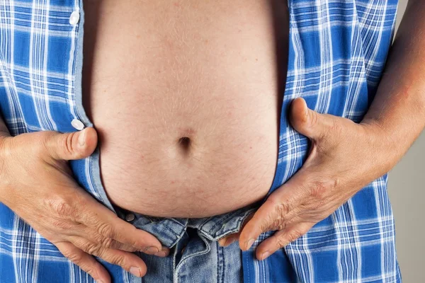 Gordo obeso. El hombre sostiene su barriga demasiado gorda. Riesgo para la salud de la obesidad . — Foto de Stock