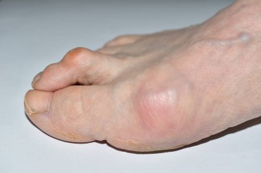 Resim bacağın sağ ayağının Hlux Valgus hastalığından etkilendiğini gösteriyor. Ayak parmakları bükülmüş..
