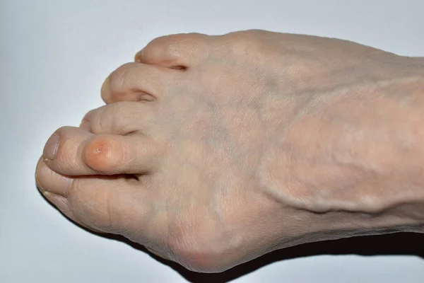 Resim Hulux valgus hastalığından etkilenen bir kadının sağ ayağının üst görüntüsünü gösteriyor..