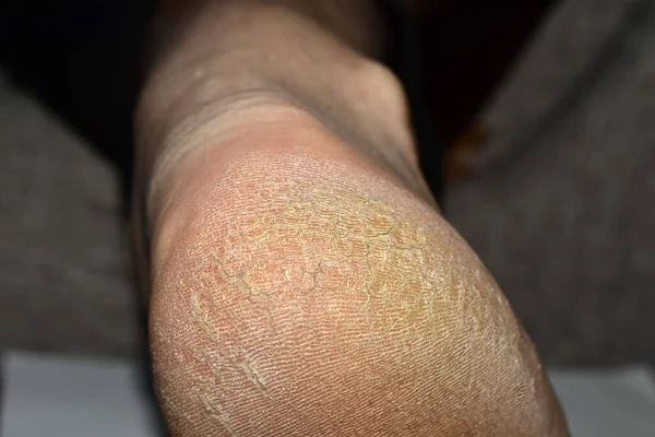 View of the heel of a man\'s right foot with cracked skin.