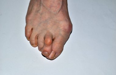 Resim bacağın sağ ayağını gösteriyor. Hallux valgus hastalığından etkilenmiş. Ayak parmakları bükülmüş..