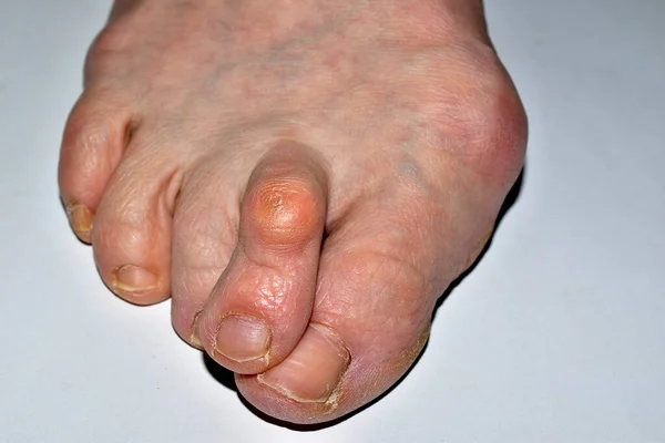 Imaginea Arată Apropiere Piciorului Drept Piciorului Afectat Boală Hallux Valgus — Fotografie, imagine de stoc