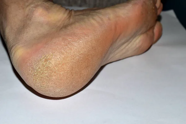 View of a man\'s foot with cracked skin on his heel.