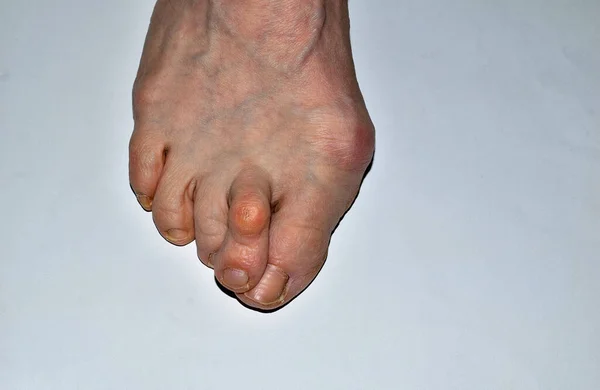 Resim bacağın sağ ayağını gösteriyor. Hallux valgus hastalığından etkilenmiş. Ayak parmakları bükülmüş..
