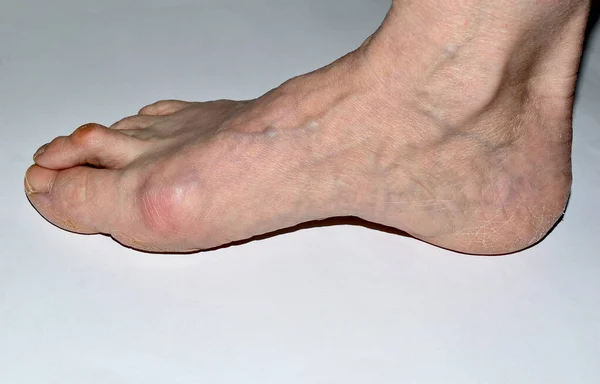 Resim, bacağın sağ ayağının Hallux Valgus hastalığından etkilendiğini gösteriyor..