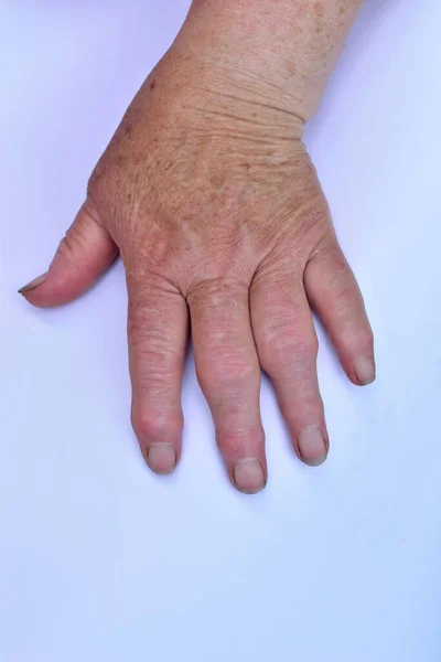 Artrite delle dita della mano sinistra di una donna. — Foto Stock