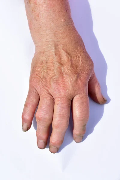 Zánět kloubů prstů ženské pravé ruky. — Stock fotografie