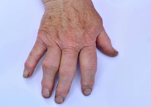 Artrite delle dita delle donne mano destra. — Foto Stock