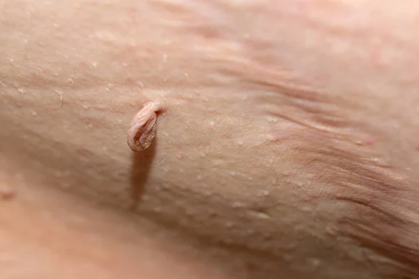 Papilloma, cerrahi dikişin yanındaki adamın karnında bulunuyor..
