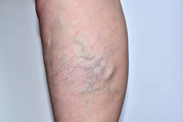 Снимок ноги женщины с варикозным расширением вен. — стоковое фото
