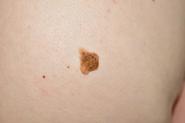 Close-up of a large mole on a womans belly. — Stock Photo, Image