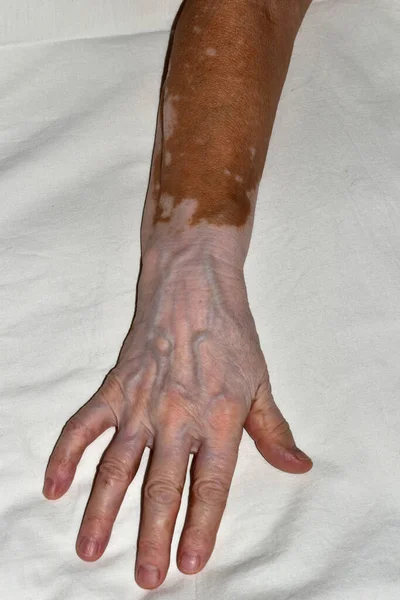 The womans right hand is damaged by vitiligo disease, with thin skin. — Stock Photo, Image