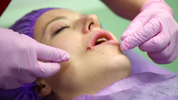 Lippenvergrößerung. Schönheitsinjektionen. Plastische Chirurgie — Stockvideo