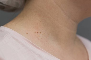 Boyun derisinde papilloma var..