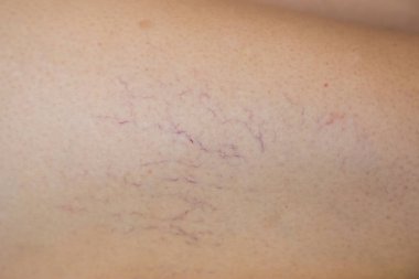 Bacaktaki örümcek damarları. Varisli damarlar..