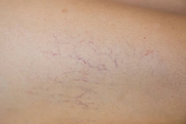 Spider veins on leg. Varicose veins.