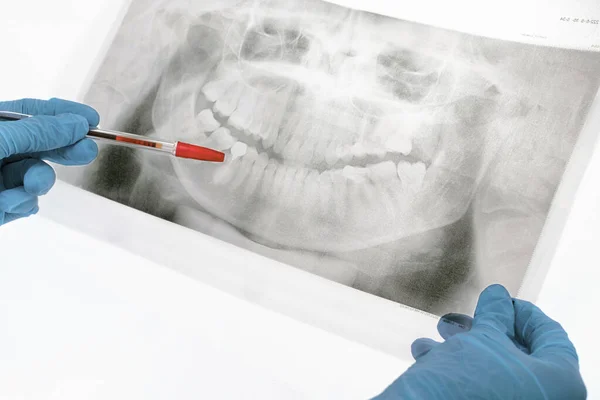 Close-up of a dentists hand in blue gloves with panoramic x-ray of the teeth in front of a light box in the dental clinic and pointing at a bad tooth with pen. Stomatology pantomogram.