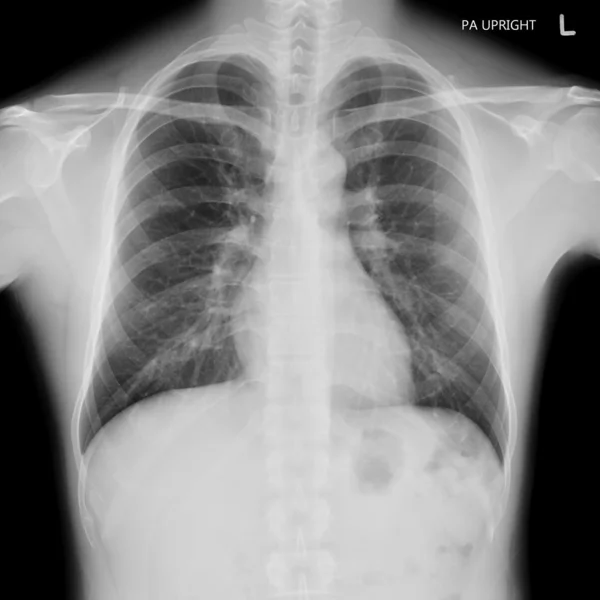 X-ray film of normal male chest — Stock Photo, Image