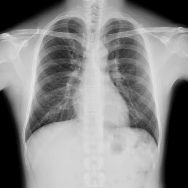 X-ray film of normal male chest — Stock Photo, Image