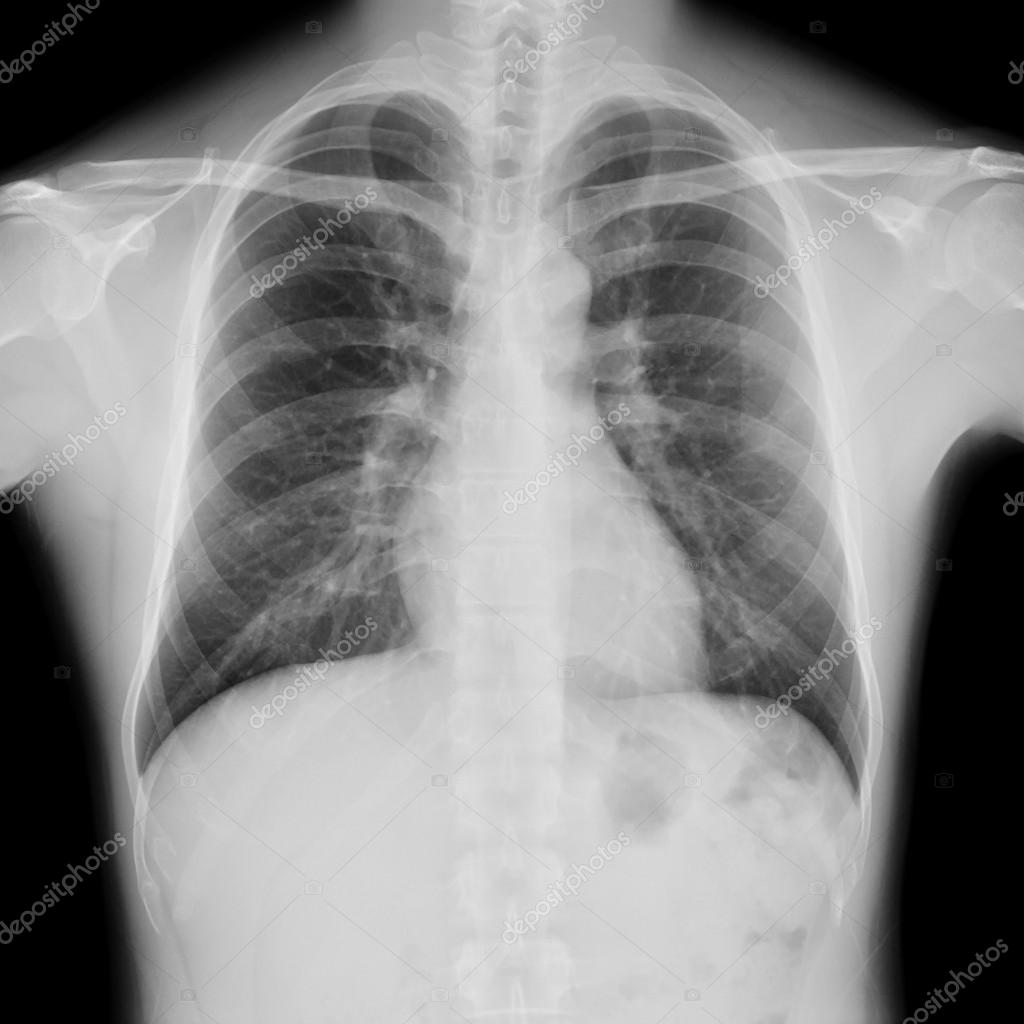 Normal Chest X Ray Male