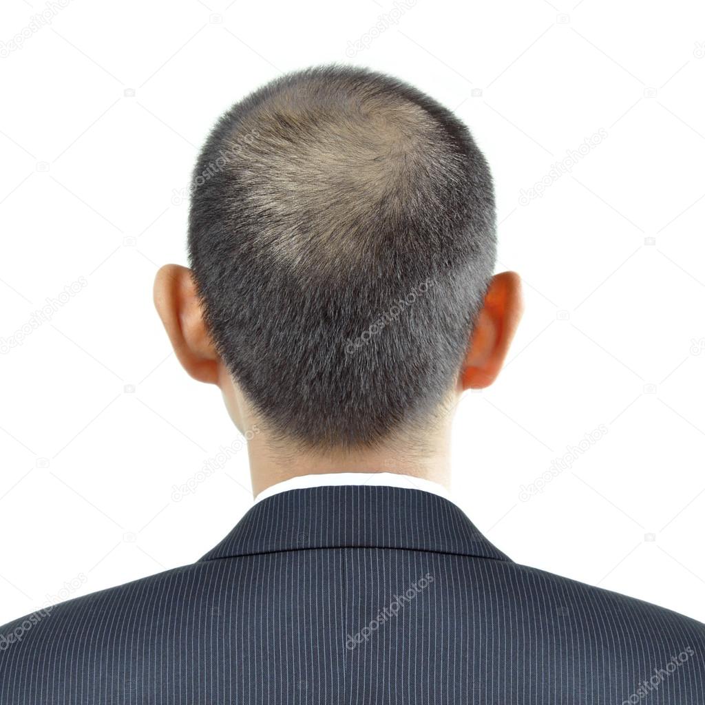 Hair thinning symptom on a man head - sign of hair loss