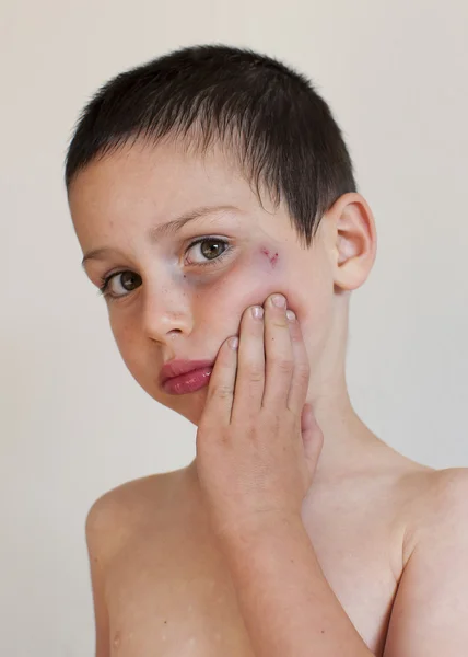 Child with bruise — Stock Photo, Image