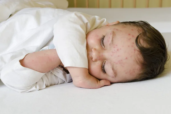 Niño con varicela — Foto de Stock