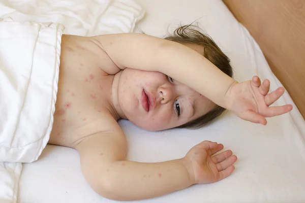 Child with chicken pox — Stock Photo, Image