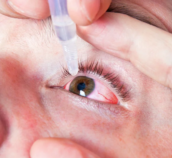 Hombre goteando gotas en el ojo inflamado, primer plano —  Fotos de Stock