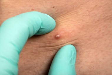 Doktorun ellerinin steril eldiven giydiği, sivilce dolu sivilceleri sıktığı bir fotoğraf.