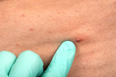 Doktorun ellerinin steril eldiven giydiği, sivilce dolu sivilceleri sıktığı bir fotoğraf.