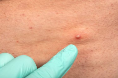 Doktorun ellerinin steril eldiven giydiği, sivilce dolu sivilceleri sıktığı bir fotoğraf.