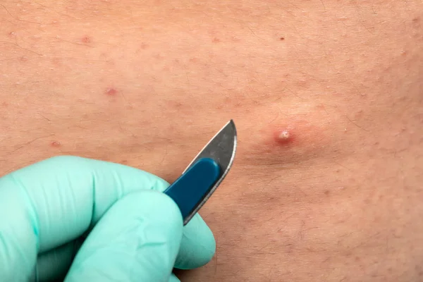 Close Picture Doctor Hands Holding Sterile Scalpel Next Painful Pimple — Stock Photo, Image