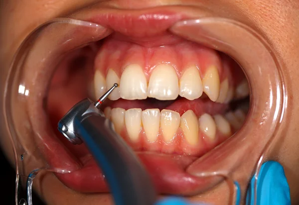 Examen dental — Foto de Stock