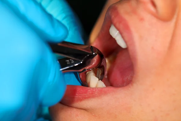 Dental extraction — Stock Photo, Image