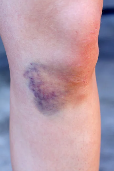 Hematoma — Fotografia de Stock