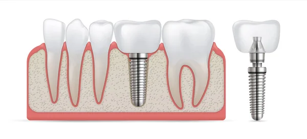 Οδοντικό εμφύτευμα Χειρουργική φροντίδα δοντιών και στερέωση στεφάνης. Αντικατάσταση δοντιών και θεραπεία πρόθεσης. Εμφύτευση τεχνητού γομφίου με μεταλλική βίδα. Μοντέλο οδοντοστοιχίας. Κοιλιακή στοματολογία — Διανυσματικό Αρχείο
