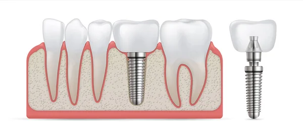 Fogászati implantátum. Fogápolási műtét és koronadísz. Fogpótlás és protézis kezelés. Műőrlőfogak beültetése fémcsavarral. Műfogsor modell. Vektorfogtan — Stock Vector