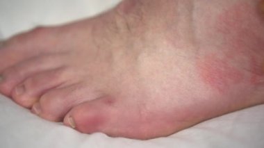 Bir adamın bacağının sıcak suyla ikinci derece yanığı. Derisi taşaklara kadar şişmişti..