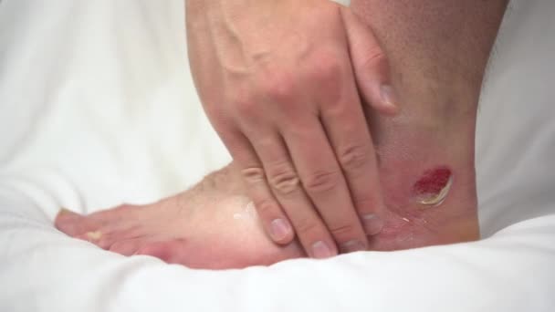 Um homem esfrega uma pomada numa perna com uma queimadura de água quente de segundo grau. A pele estava inchada em pedaços. — Vídeo de Stock