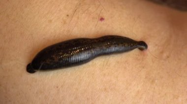 İnsan vücudundaki tıbbi sülük kan içer. Sülüklerle tedavi edilmek. Makro video.