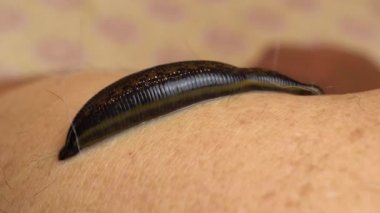 İnsan vücudundaki tıbbi sülük kan içer. Sülüklerle tedavi edilmek. Makro video.