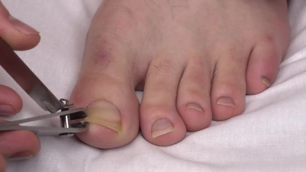 Um homem corta as unhas dos pés de perto. Unhas de fungos são cortadas com garras especiais. — Vídeo de Stock