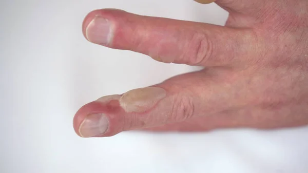 Close-up - burn of a mans hand with hot water of the second degree. The skin is swollen with blisters. — Stock Photo, Image