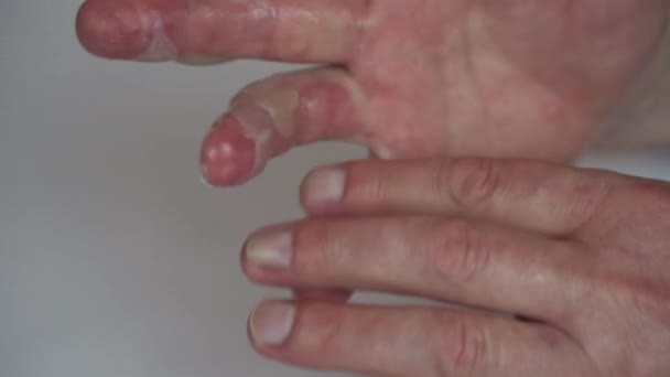 En man smetade salva på handen med en andra gradens varmvattenskada. Huden är svullen av blåsor. — Stockvideo