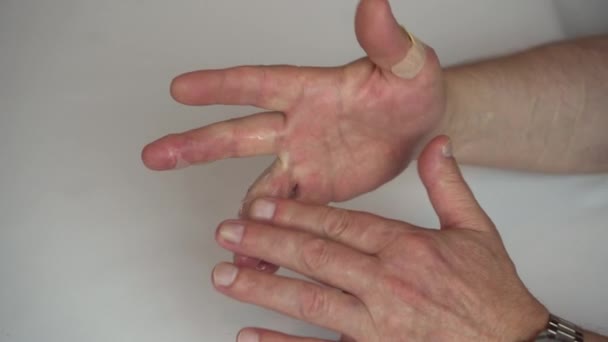 Seorang pria mengoleskan salep di tangannya dengan luka bakar air panas tingkat dua. Kulitnya membengkak dengan lecet. — Stok Video