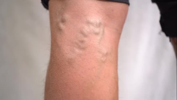 Varicose veins can be seen under the skin on the leg men closeup. — Stock Video