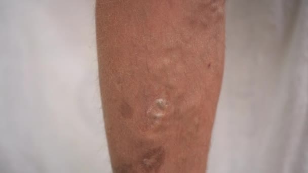 Varicose veins and age spots on the human leg. Leg on a white background. — Stock Video