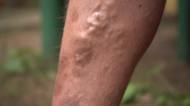 Primo piano delle vene varicose e delle macchie di età su una gamba umana. — Video Stock