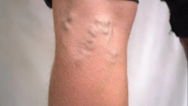 Варикозные вены можно увидеть под кожей на ногах мужчин крупным планом. — стоковое фото